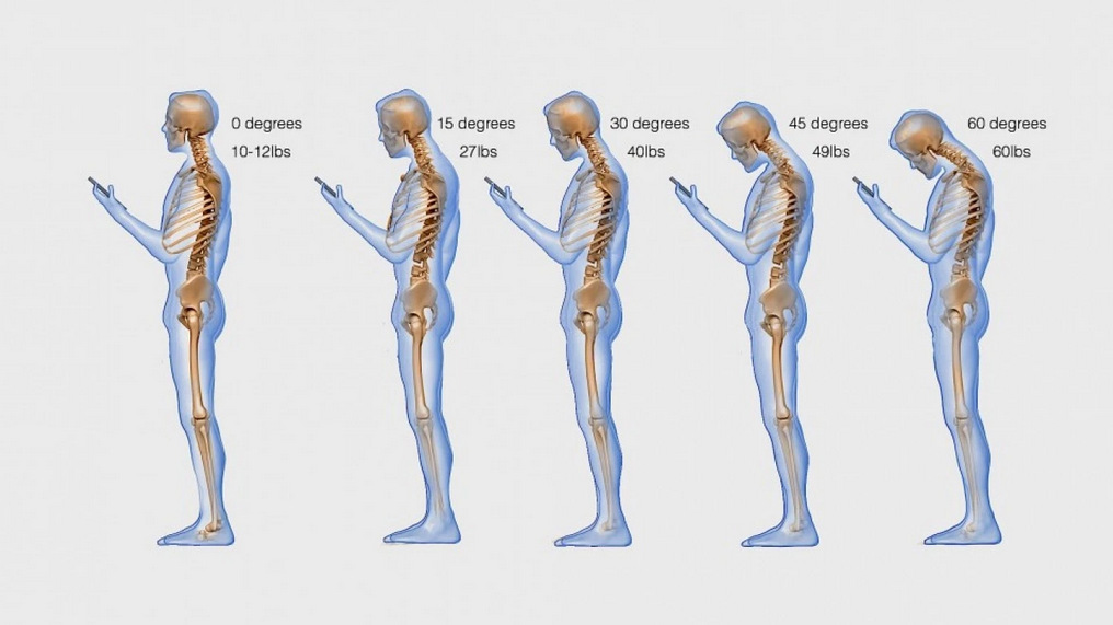 Text neck enfermedad (6)